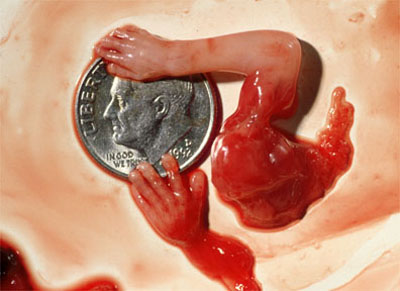 Aborted 10 Weeks A
