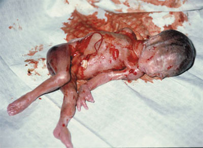 Aborted 22 Weeks B